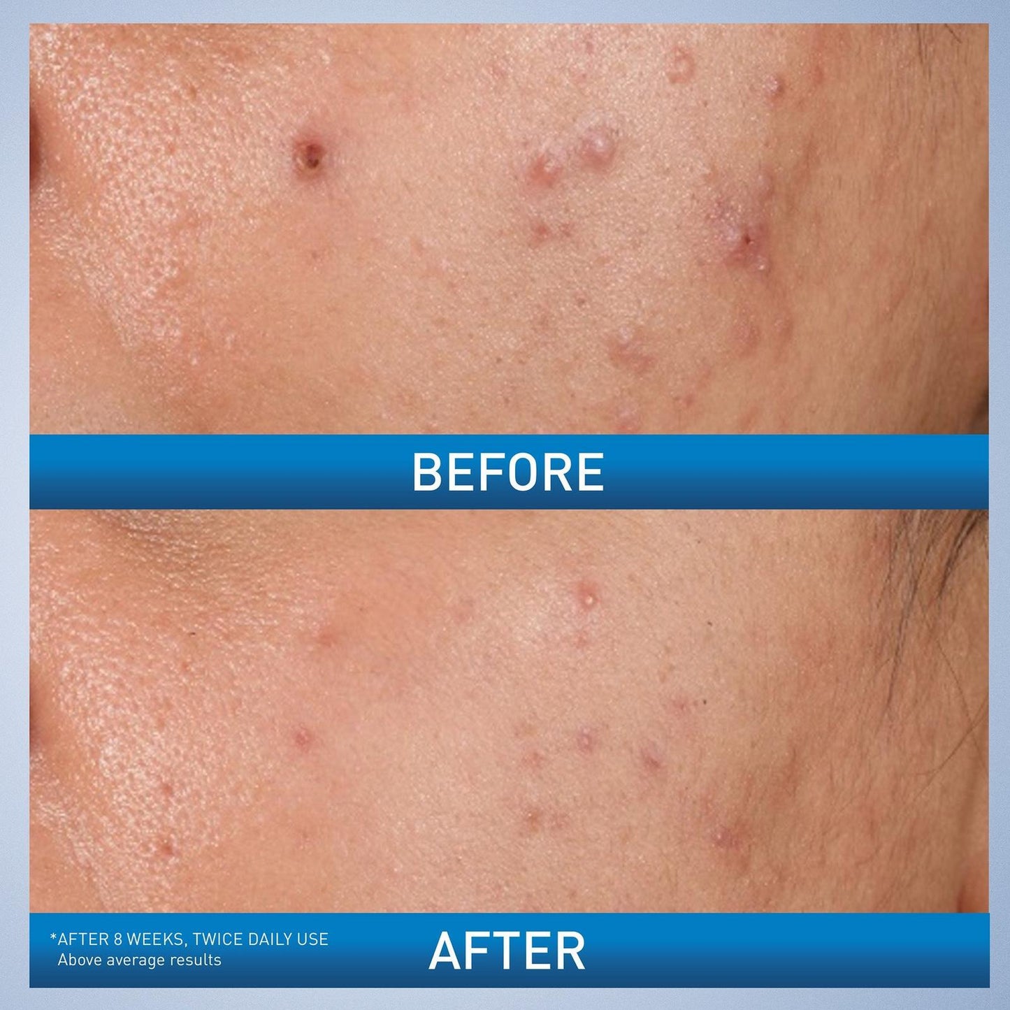 CeraVe - Acne Control Gel